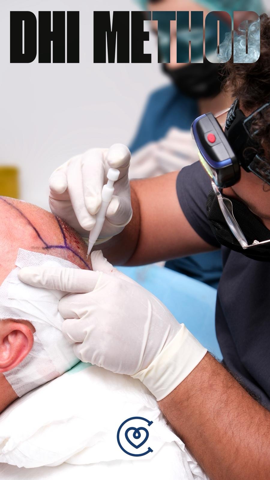 DHI-Methode Haartransplantation