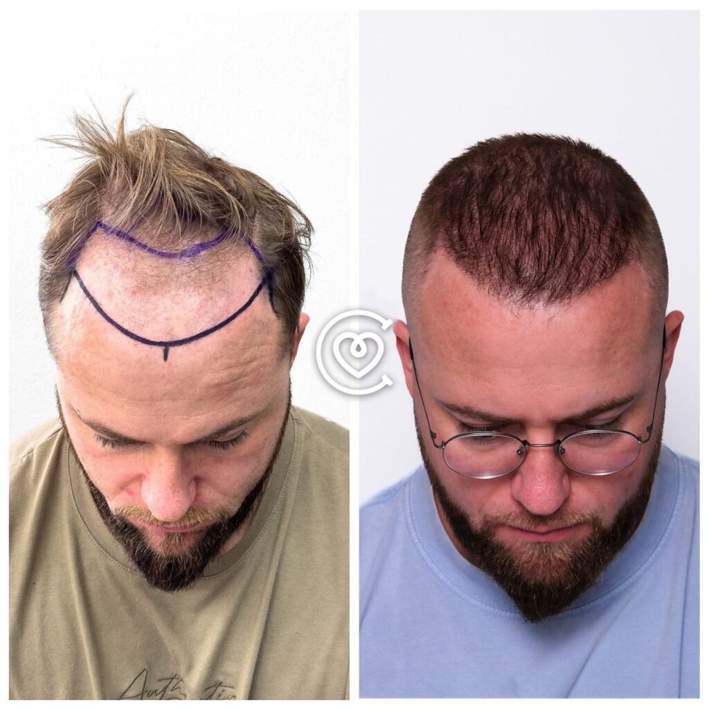 Vorher-Nachher-Bilder einer Haartransplantation