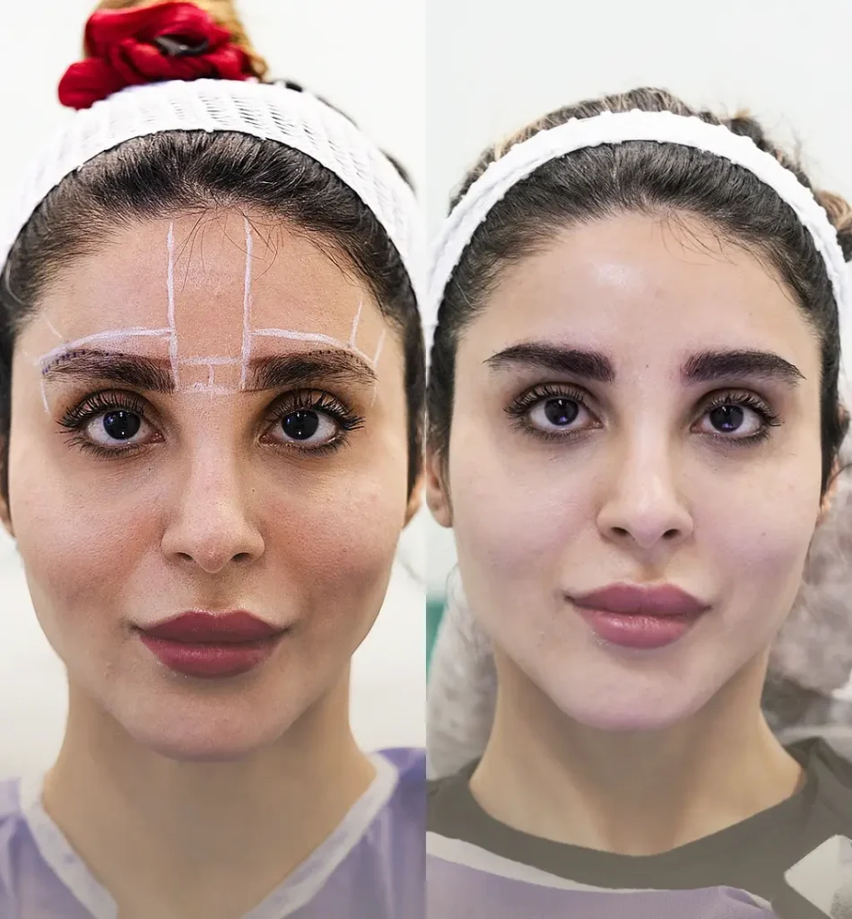 Augenbrauentransplantation Türkei