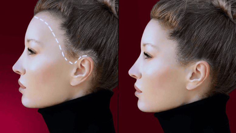 Frauen-Haartransplantation Türkei