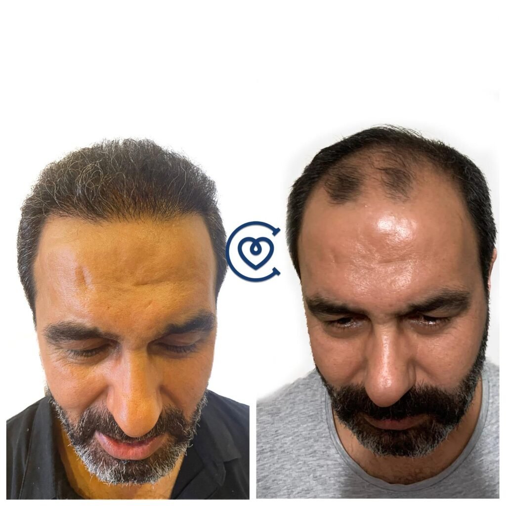 Haartransplantation Istanbul