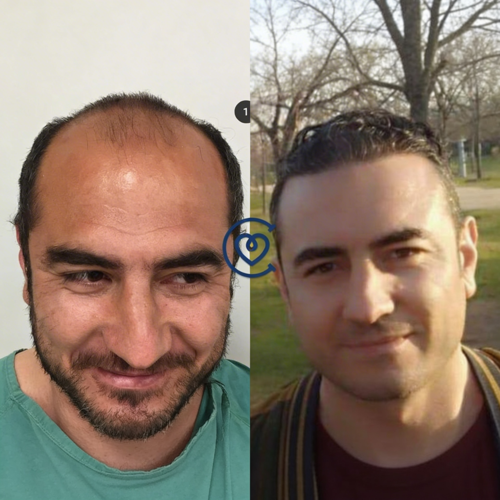 Haartransplantation Korrektur Turkei