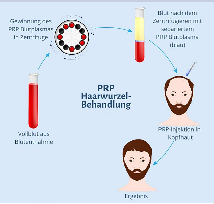 PRP Therapie Haartransplantation Antalya