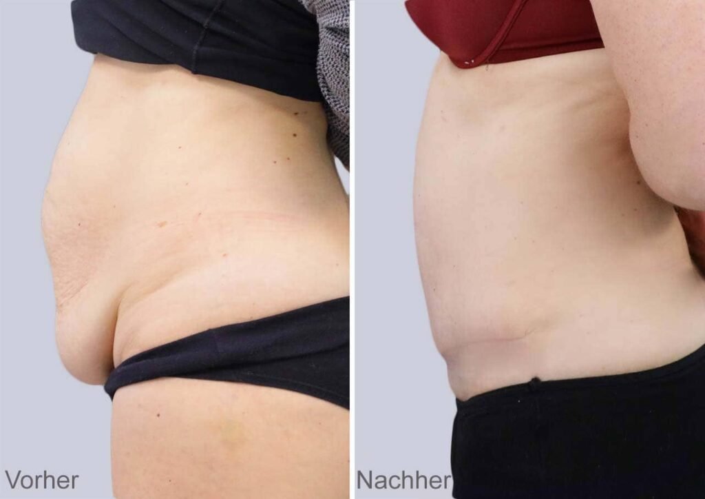 Bauchstraffung vs. Mini-Bauchstraffung
