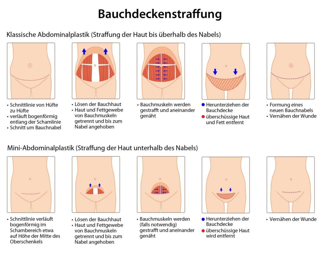 Bauchstraffung nach Gewichtsverlust