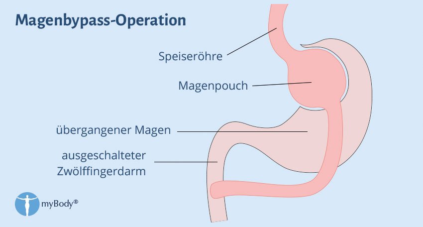 Magenband vs. Magenbypass