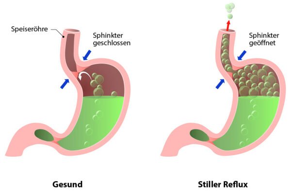 Wann Reflux nach dem Magenbypass auftreten kann
