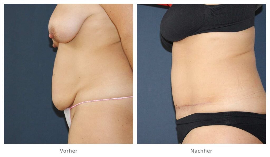 Kaiserschnitt mit dem Bauch passiert