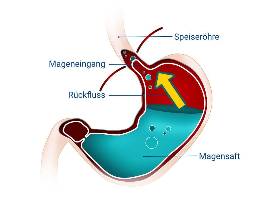 Wann Reflux nach demauftreten kann