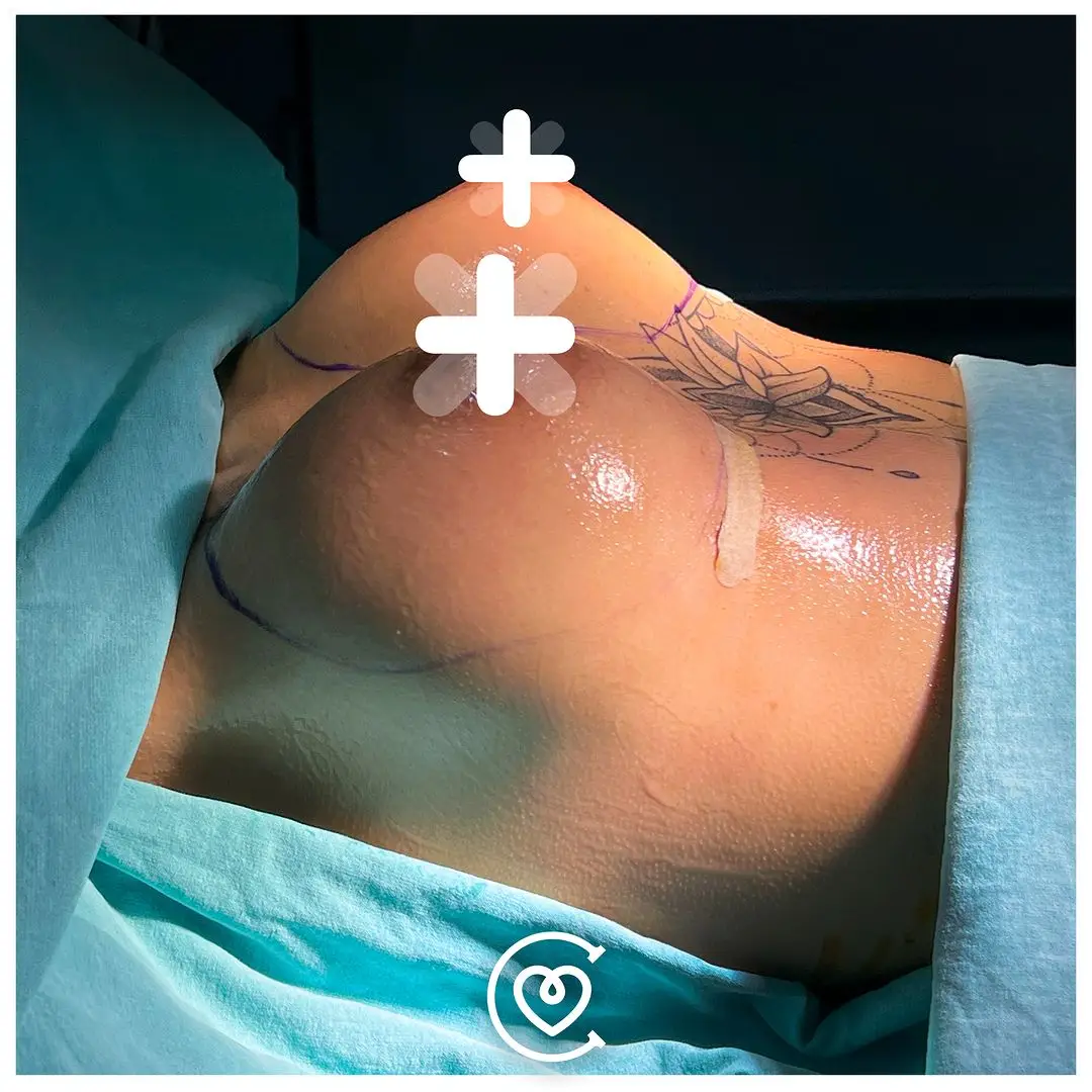Brustchirurgie
