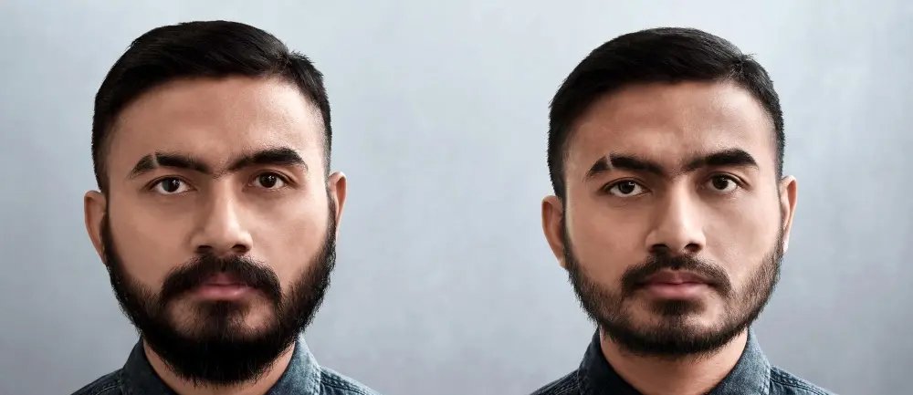 Barttransplantation