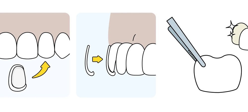 Zahnveneers