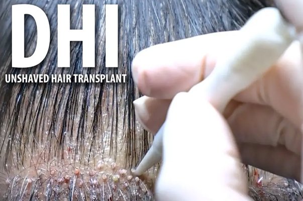 DHI-Haartransplantation
