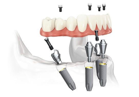 All on 4 Implantate Türkei Guide