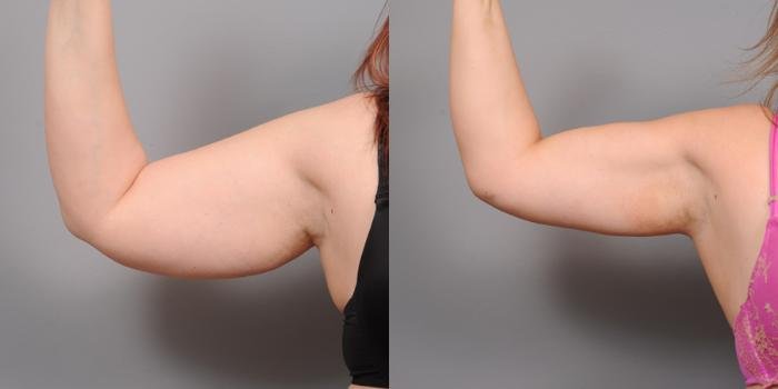 Arm-Fettabsaugung vorher und nachher