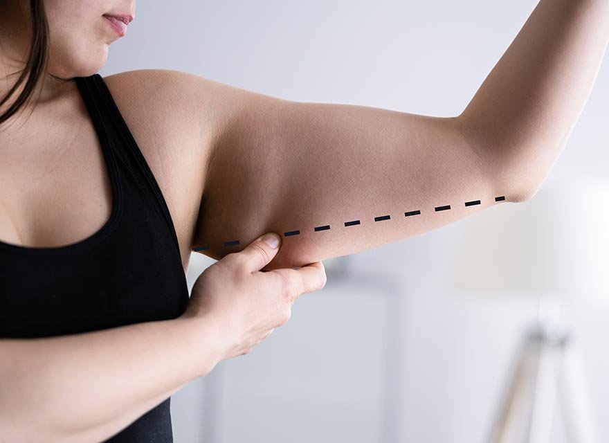 ArmFettabsaugung