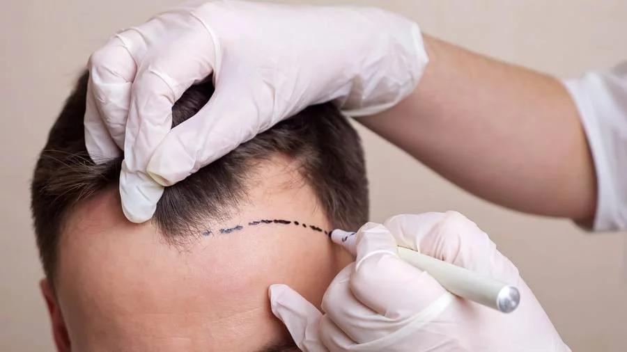 Haartransplantation