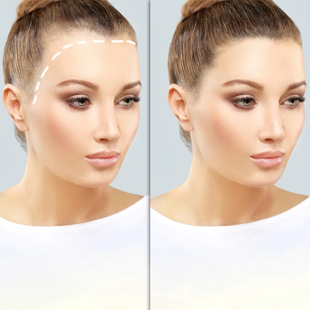 Frauen-Haartransplantation