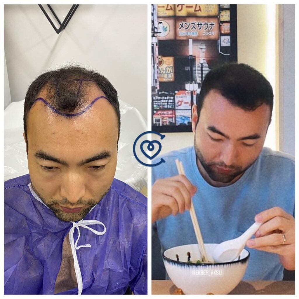 Haartransplantation Korrektur