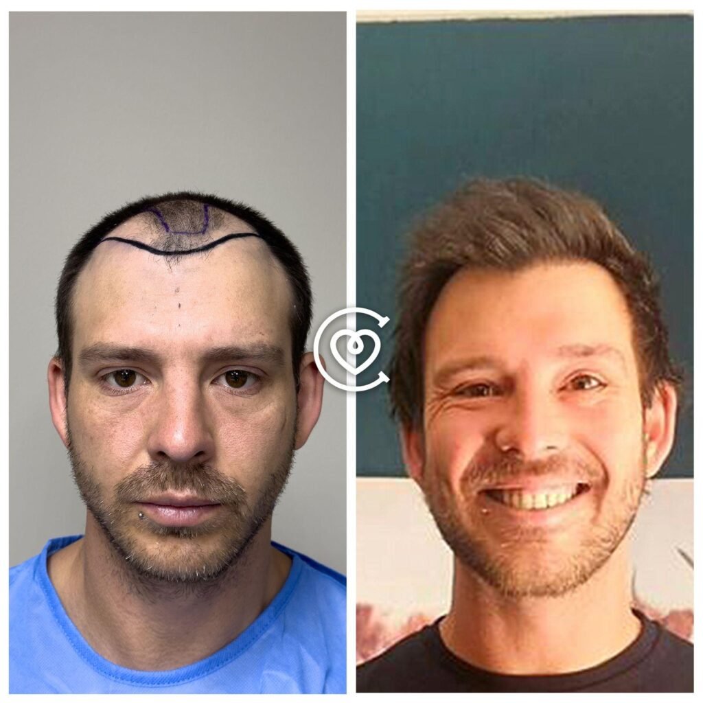 Haartransplantation in Istanbul
