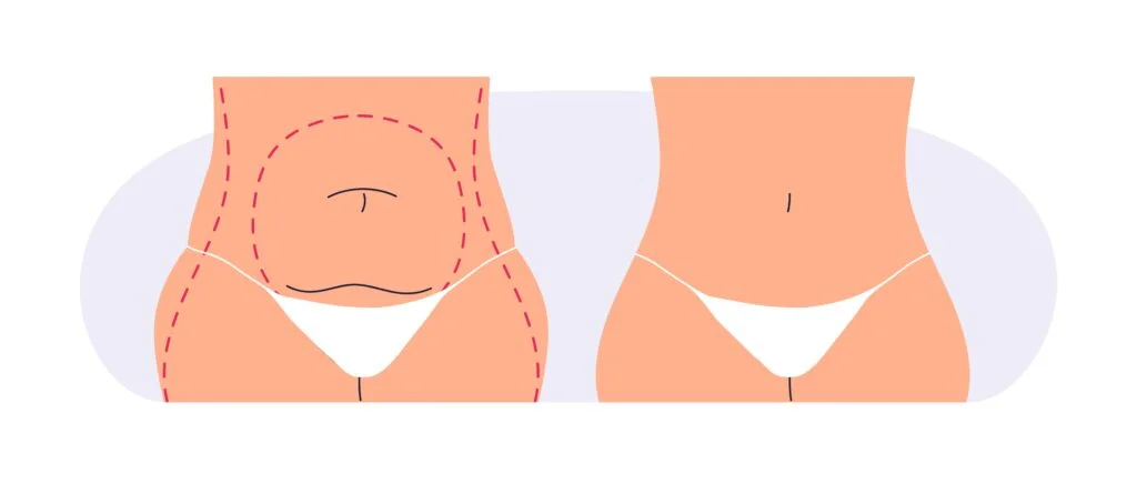 Mommy Makeover in der Türkei
